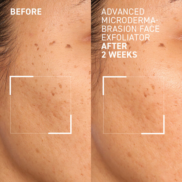 Advanced Microdermabrasion Face Exfoliator (Kuva 3 tuotteesta 4)