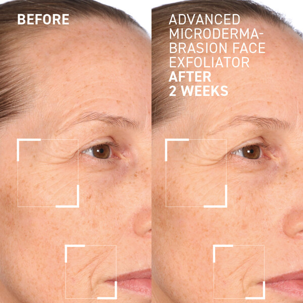 Advanced Microdermabrasion Face Exfoliator (Kuva 4 tuotteesta 4)